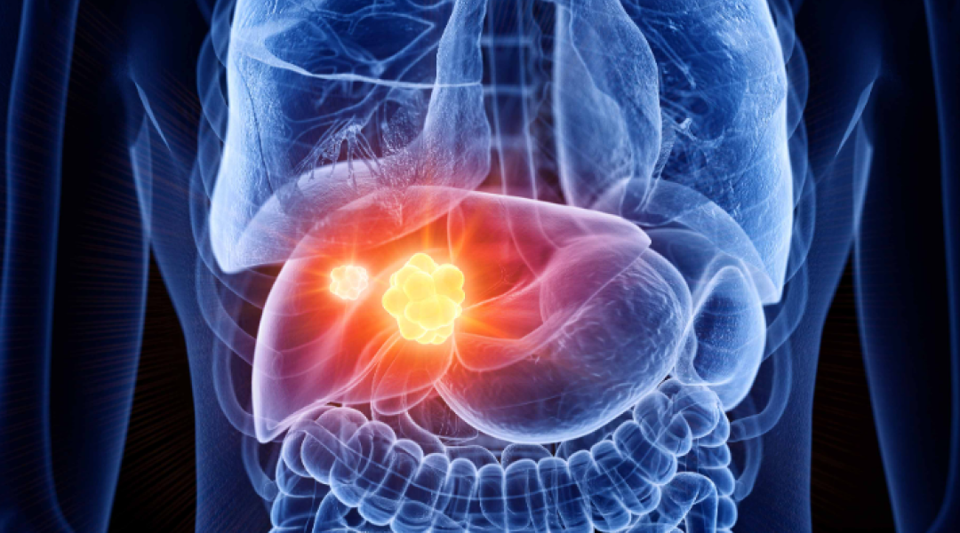 Liver Cancer