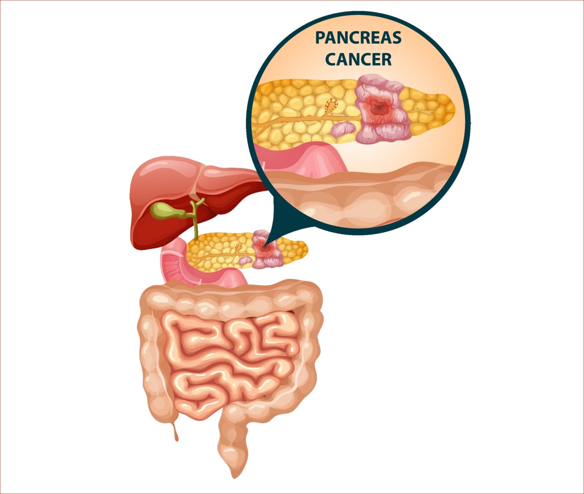 November Is Pancreatic Cancer Awareness Month: Why Early Detection Matters